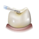 Ohio Forge Single-Use Diamond, Sterile